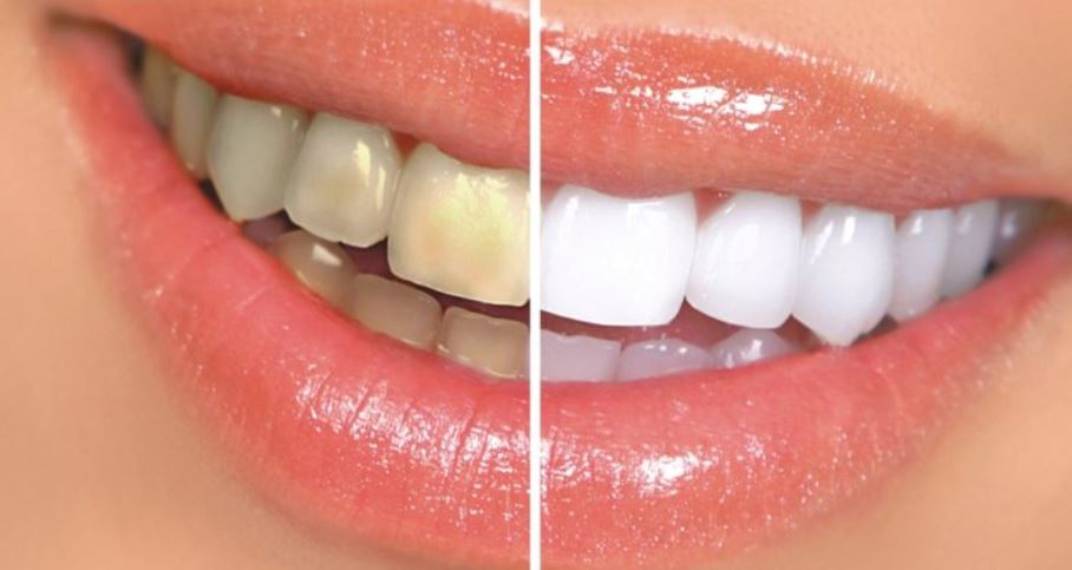 Blanchiment ZOOM Philips